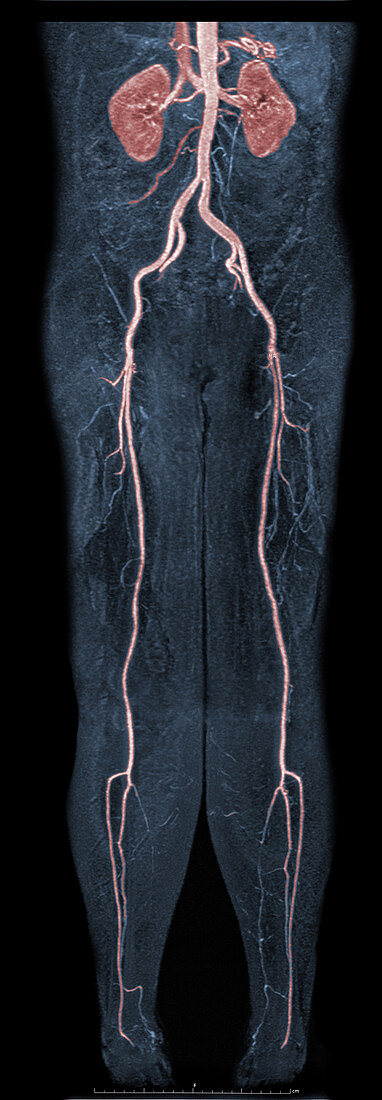 Femoral Artery Stenosis,MRA