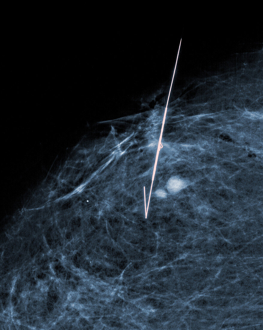 Stereotactic Biopsy of Breast