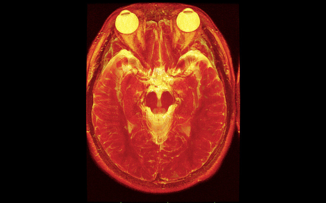 MRI of Normal Brain