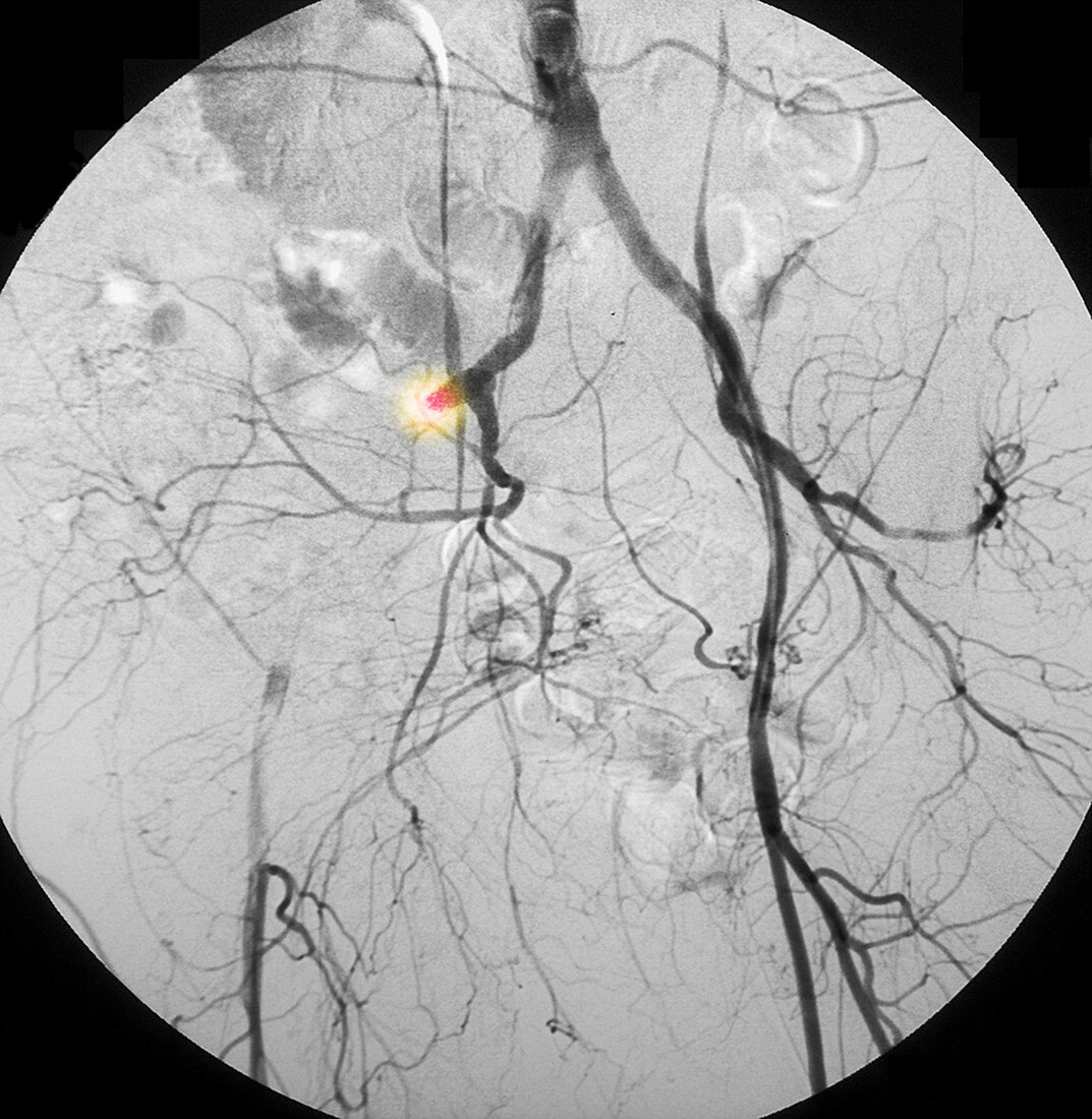 Stenosis of External Iliac Artery
