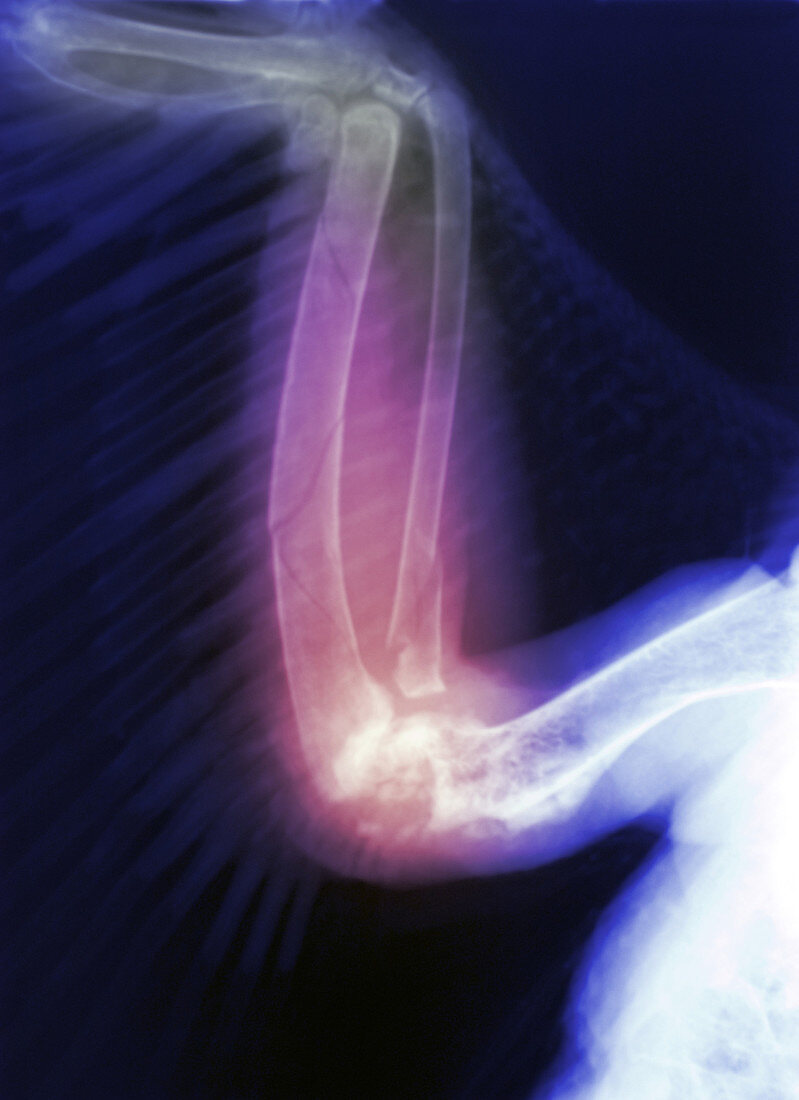 X-Ray of Broken Wing