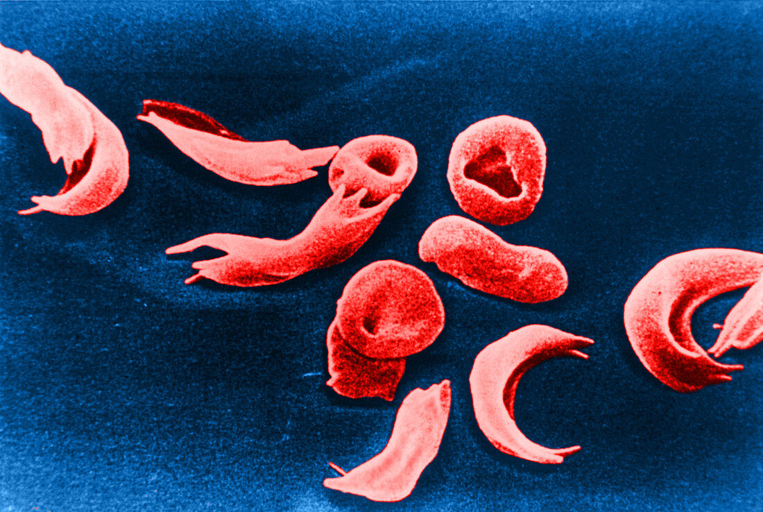 Sickle-cell anemia,SEM