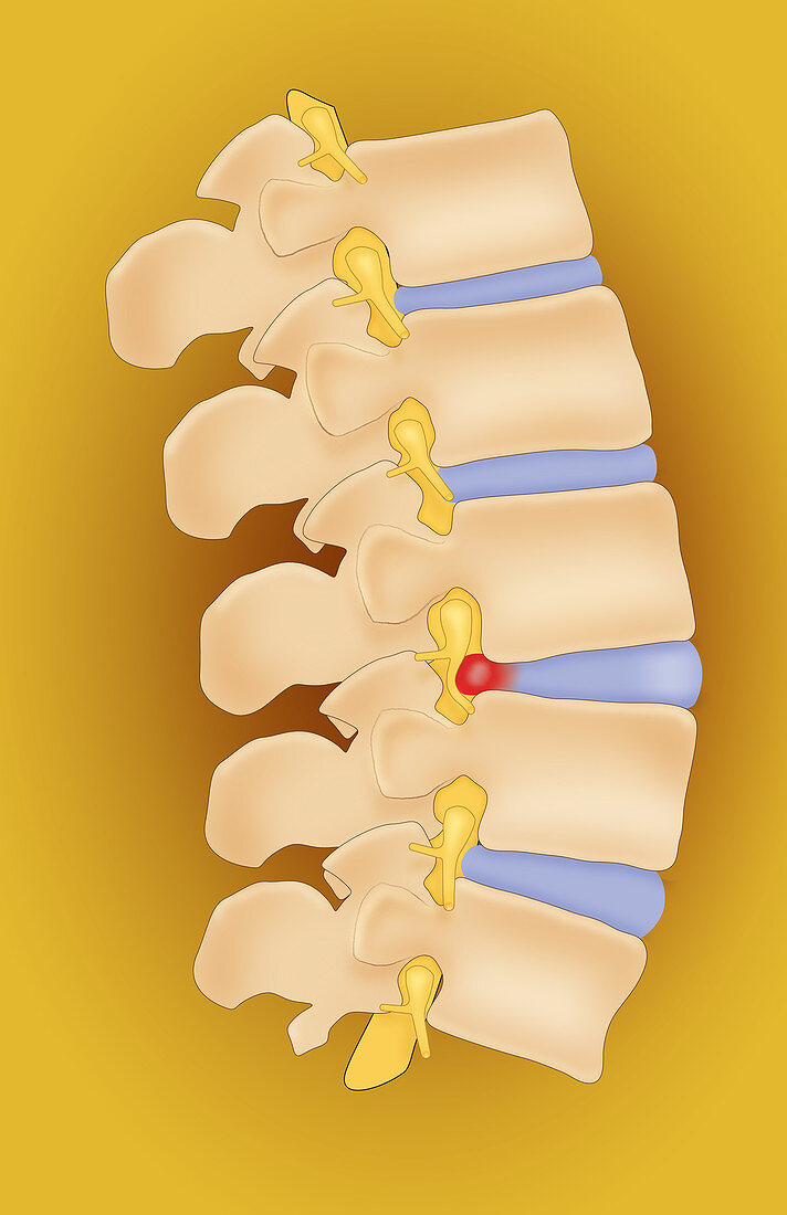 Herniated Disk