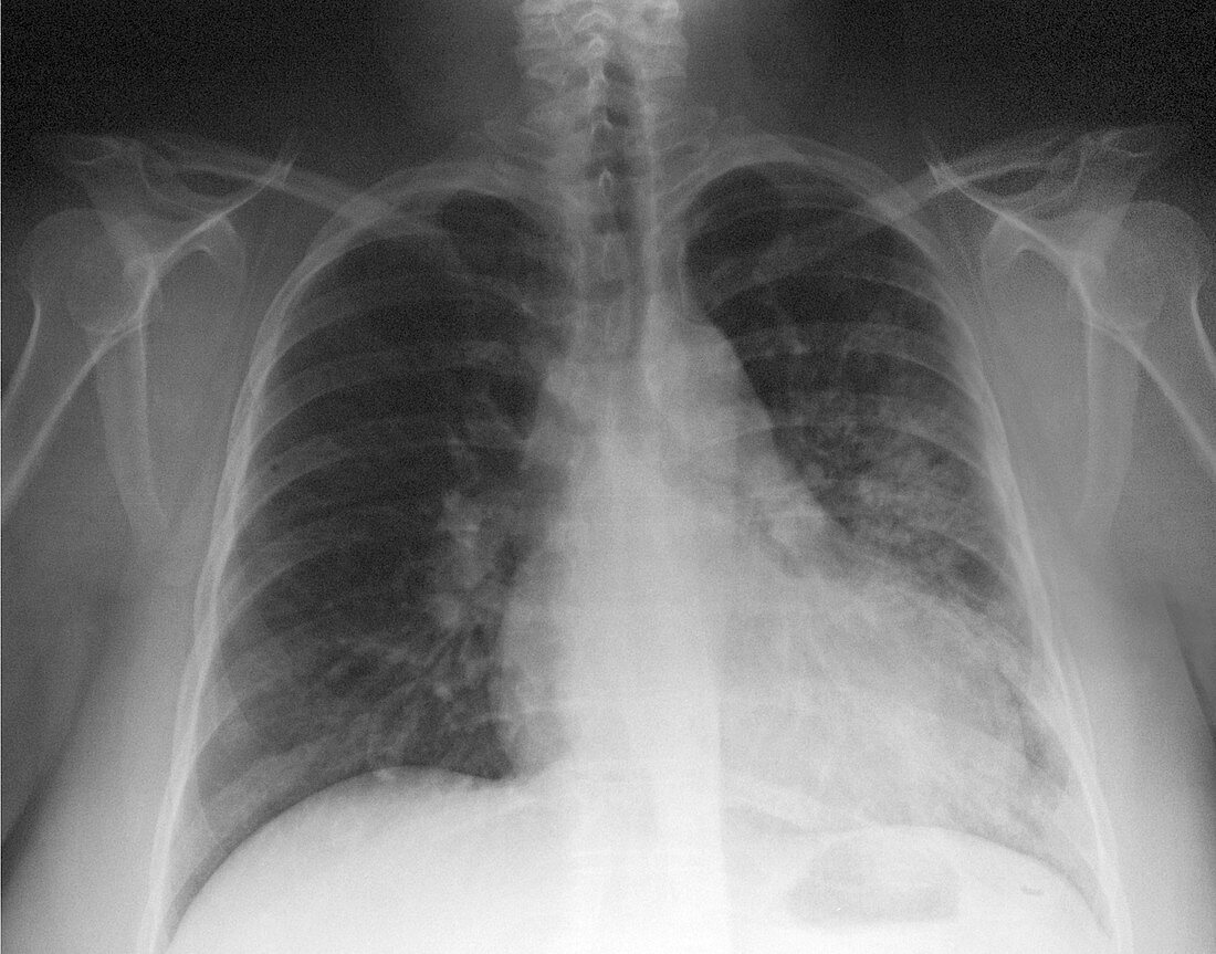 Pneumonia,X Ray