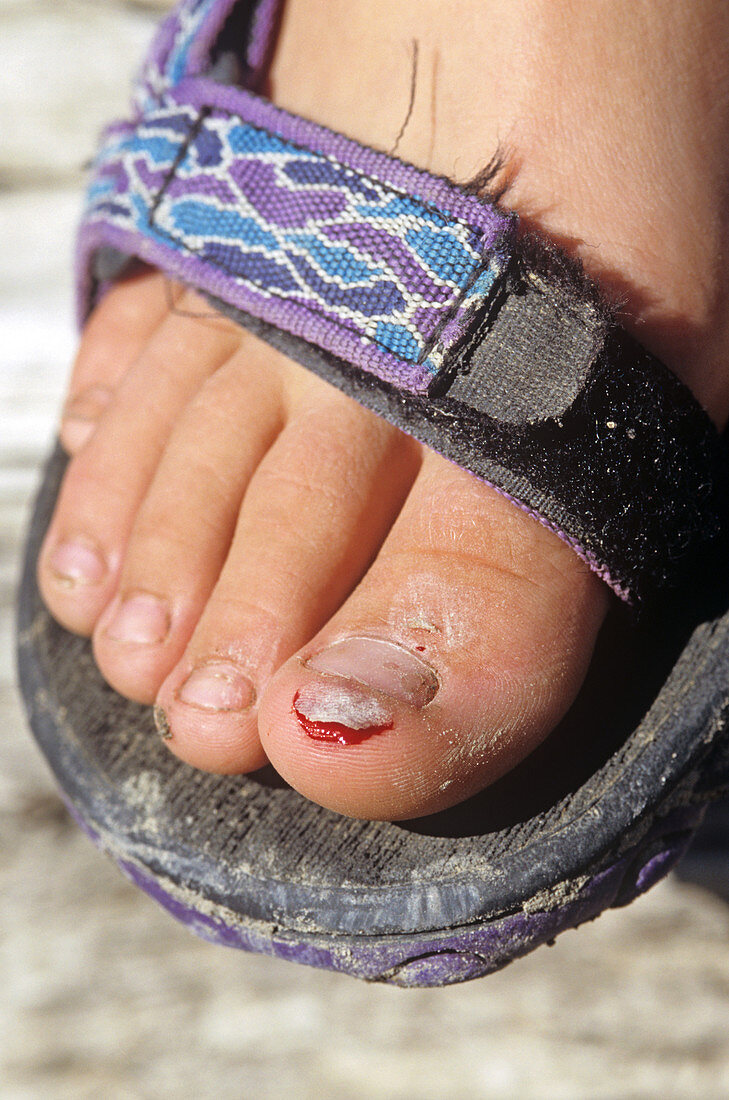 Injured Toe