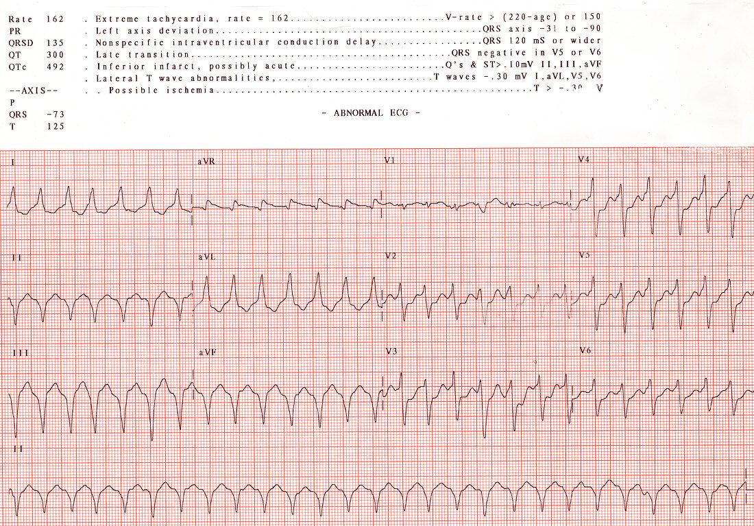 Abnormal EKG