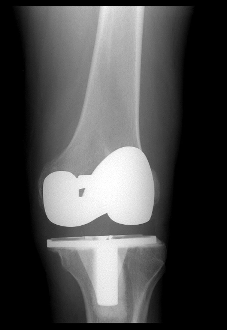 Xray of Total Knee Replacement