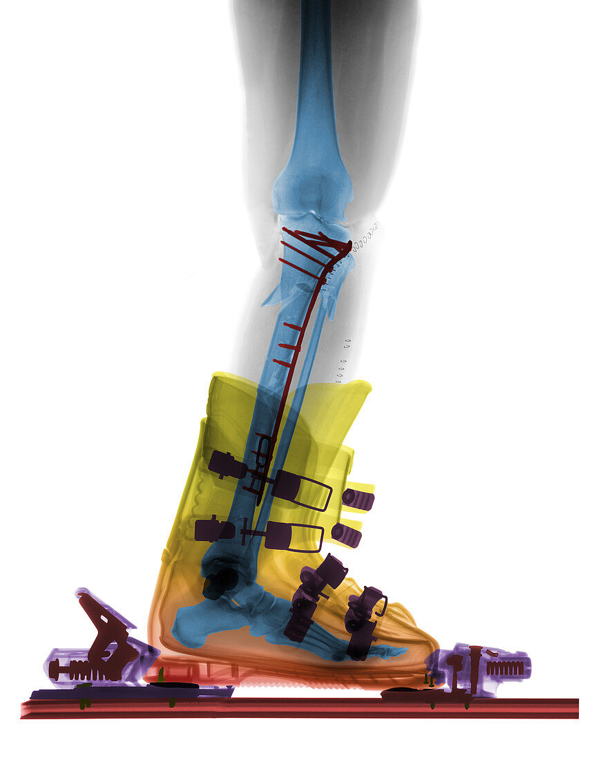 X-ray of Broken Bones in Ski boot