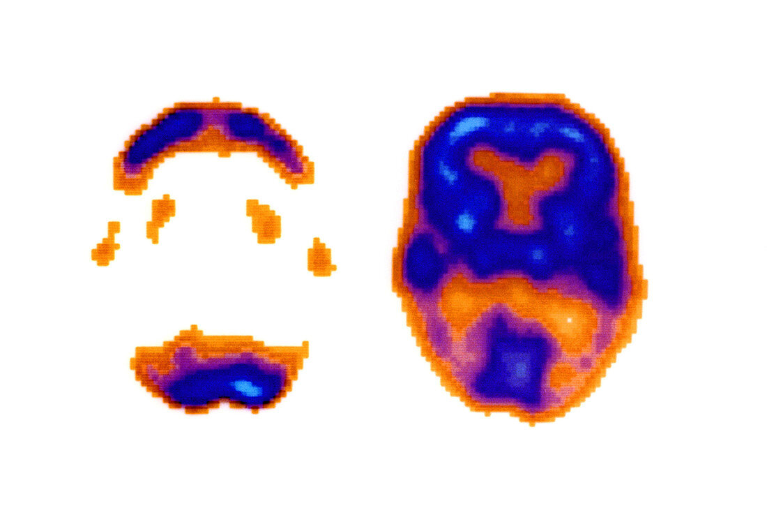 Normal and Alzheimer's Brain Scans