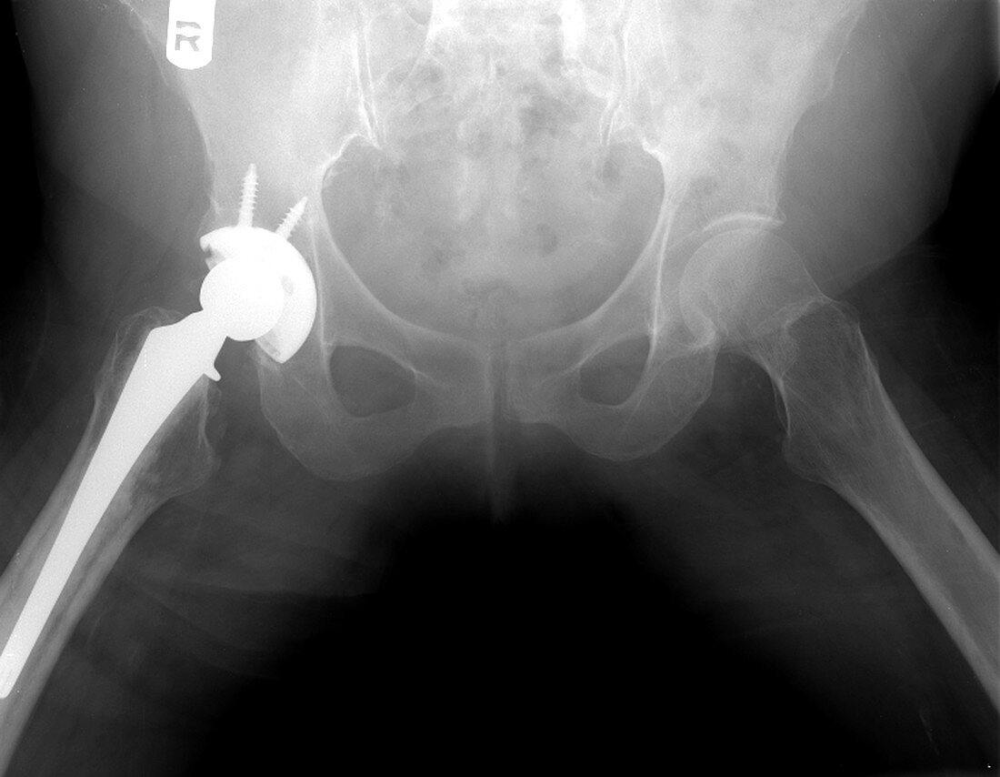 Pelvic Xray of Total Hip Replacement