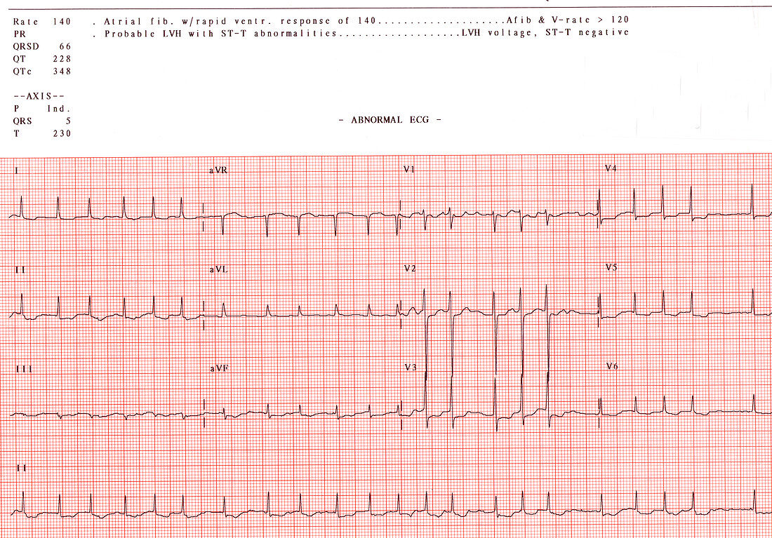 EKG,Atrial Fibrillation