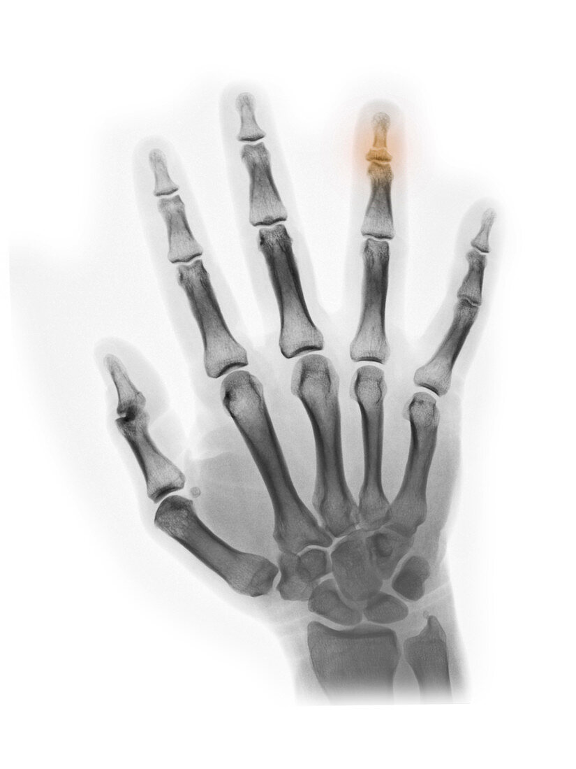 X-ray of Broken Fingertip