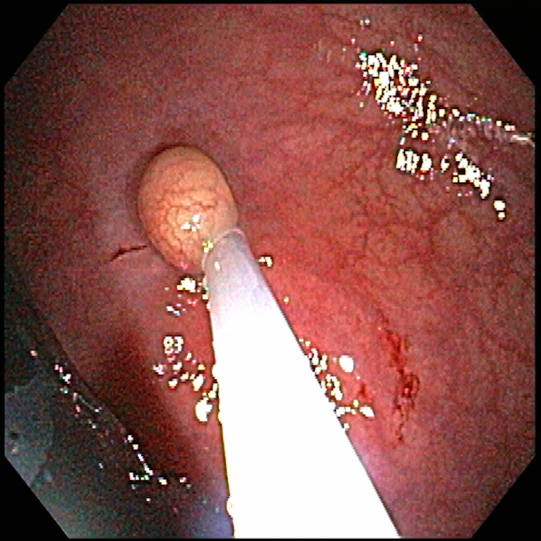 Removal of Rectal Carcinoid