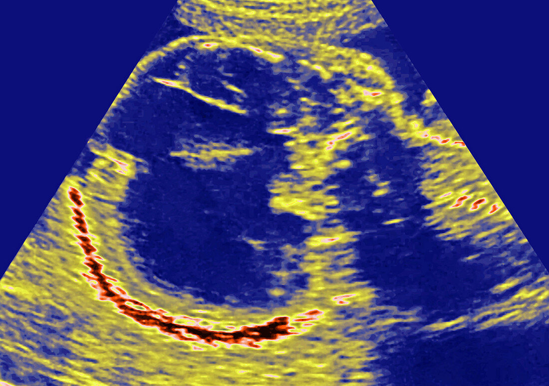 Hydrocephalic Fetus