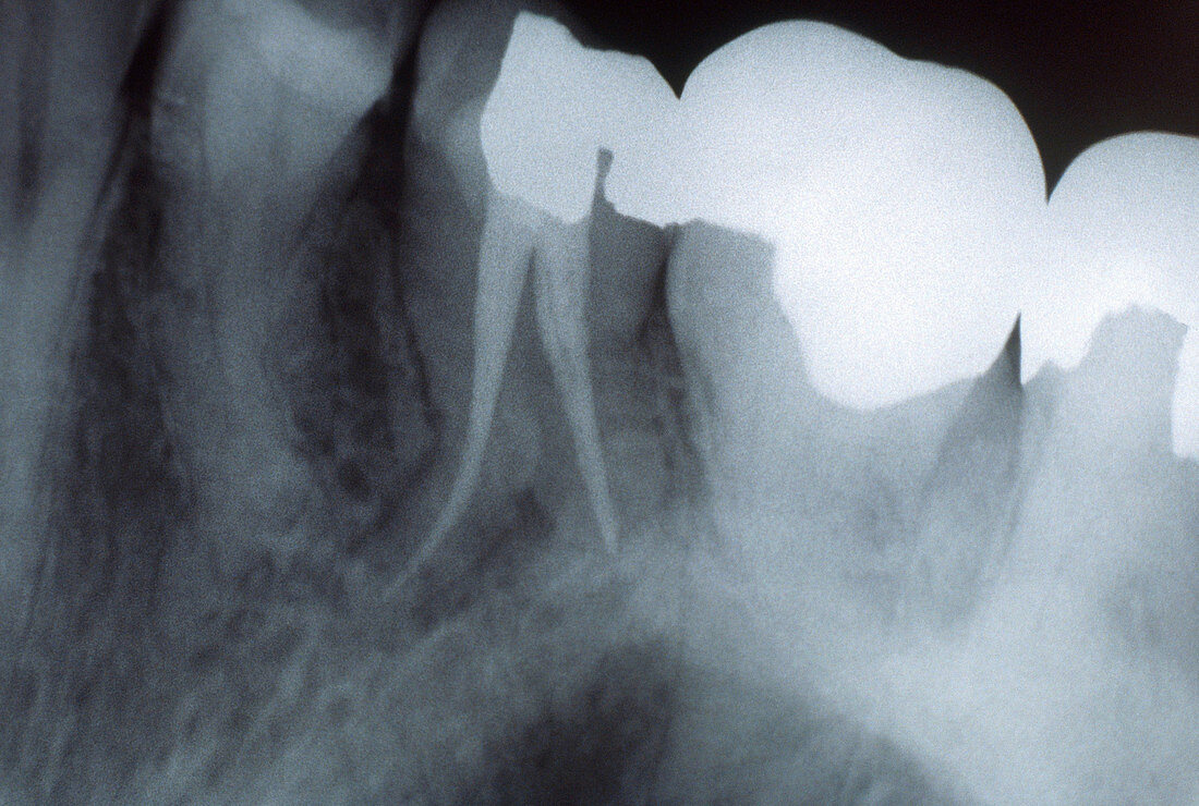 Dental Work,X-ray