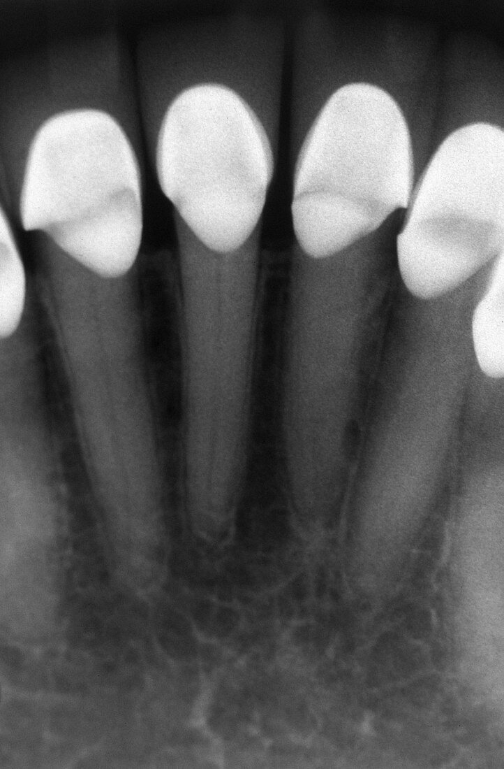 Crowns and Fillings,X-ray