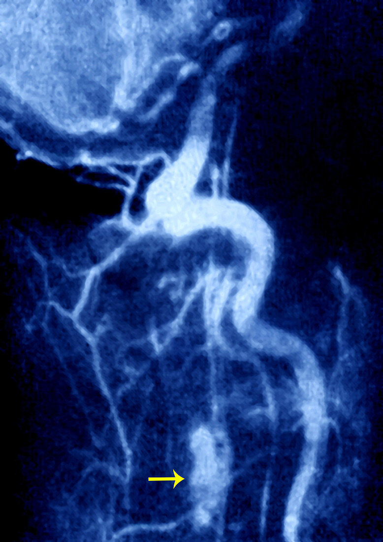 Medullary angioma