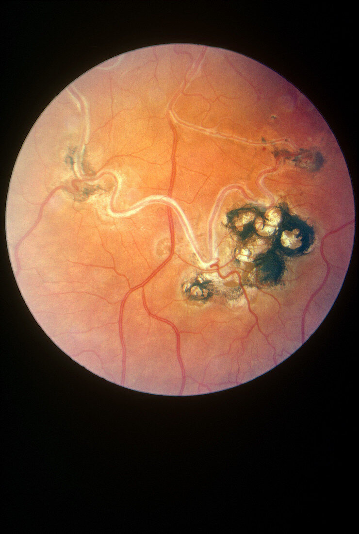 Laser Coagulation of Retinal Aneurism