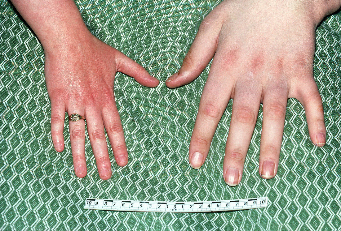 Normal and Acromegalous Hands