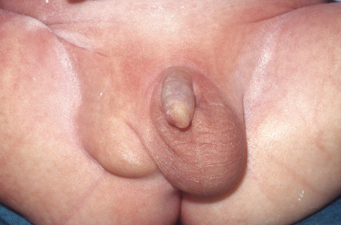 Hydrocele testis and ectopic testicle