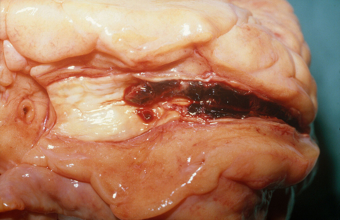 Thrombosis