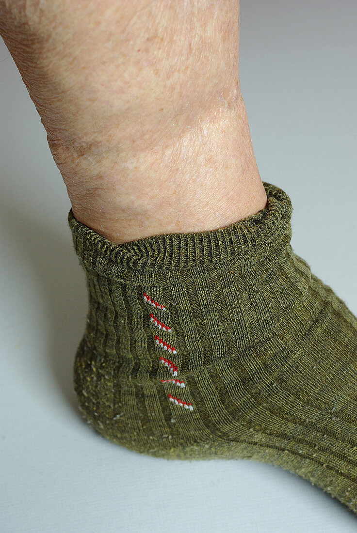 Elastic in socks impairing blood flow