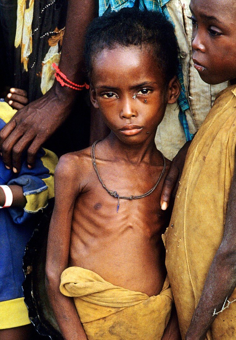 Somali children at feeding centre