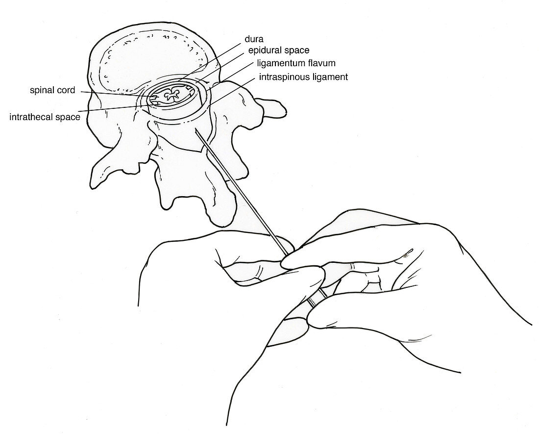 Illustration of Lumbar Puncture