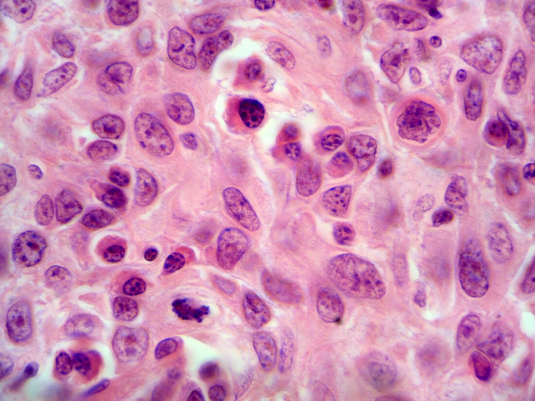LM of Squamous Cell Carcinoma