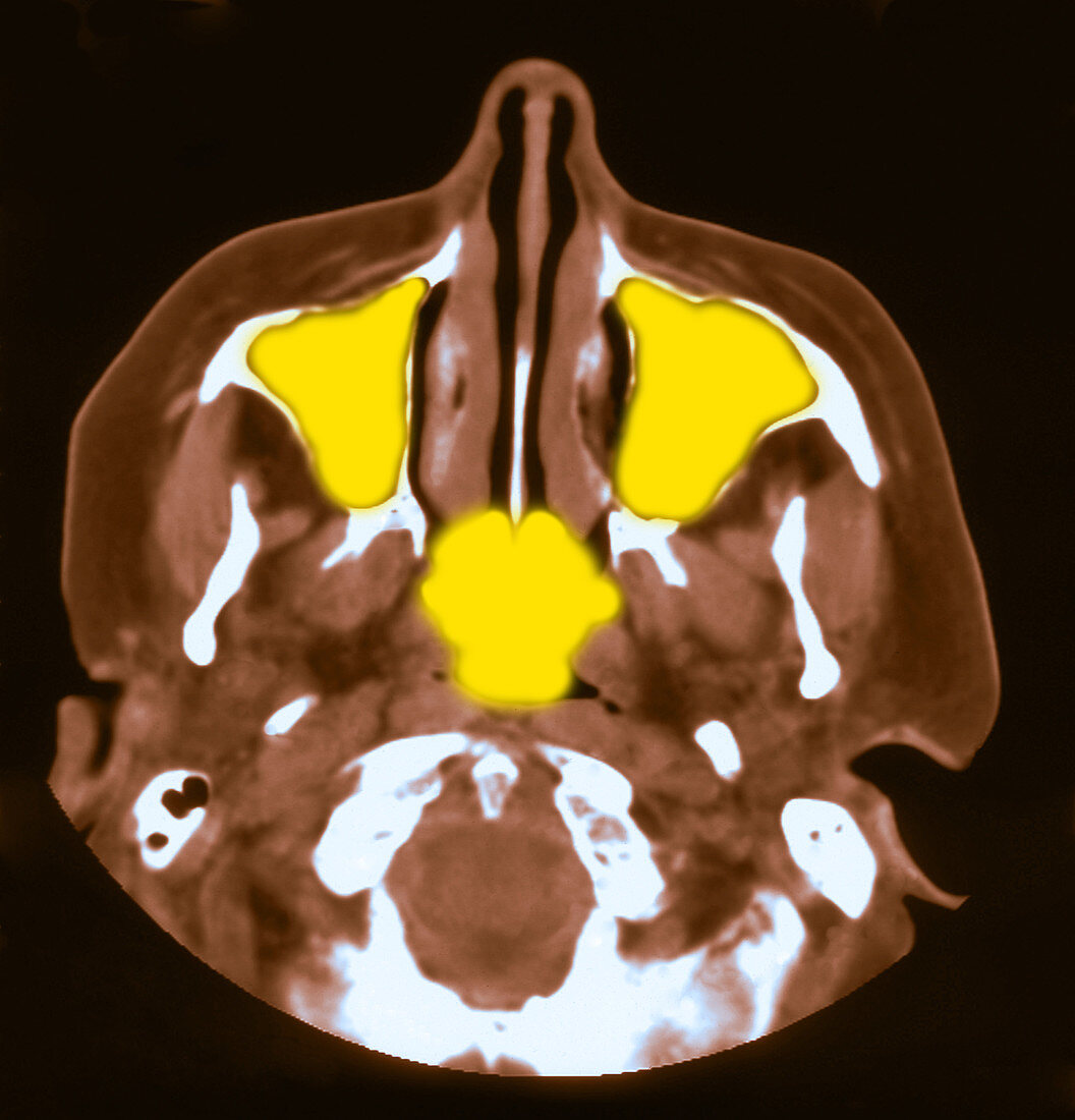 Normal MRI of Sinuses