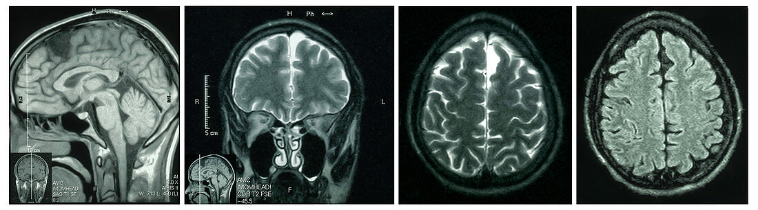 MRIs of Arachnoid Cyst