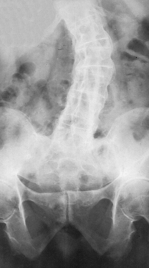 Ankylosing Spondylitis,X-Ray