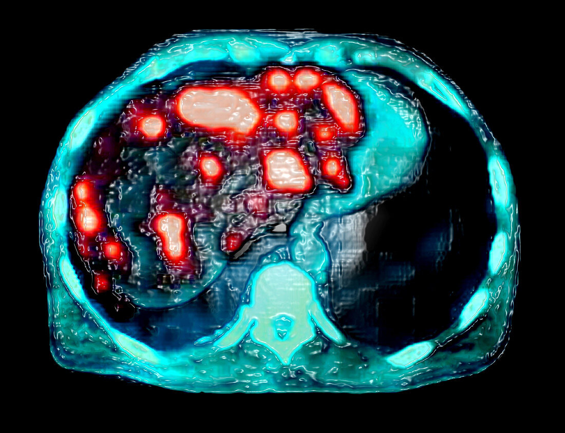 Liver Metastases (PET CT Scan)
