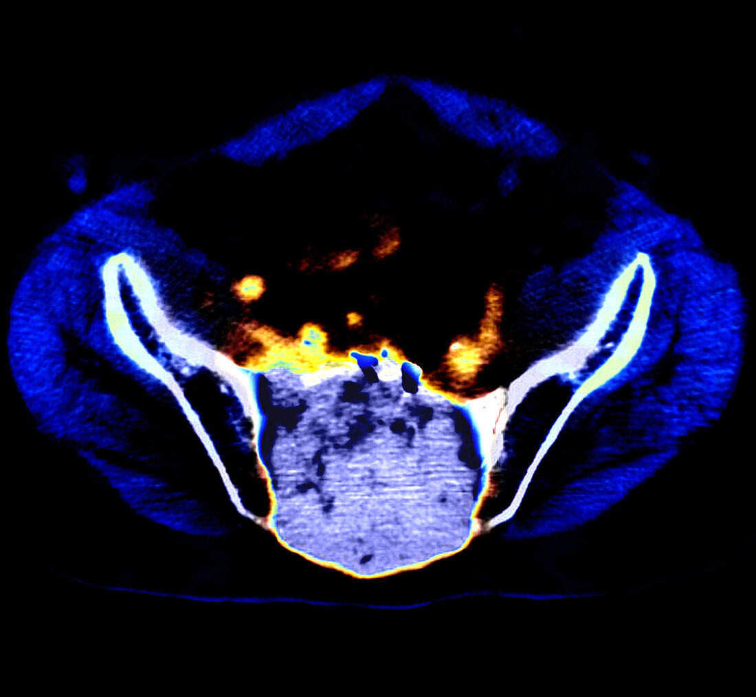 Sacral Metastasis (PET CT Scan)