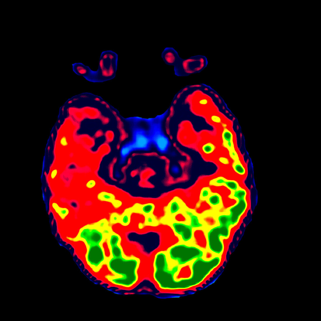 Mesial Temporal Sclerosis (PET Scan)