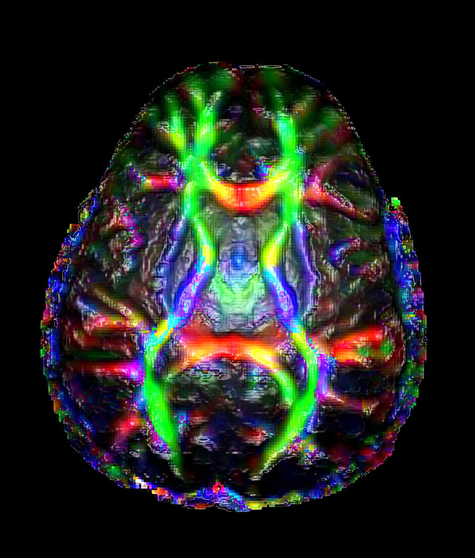 Normal Brain (Diffusion Tractography)