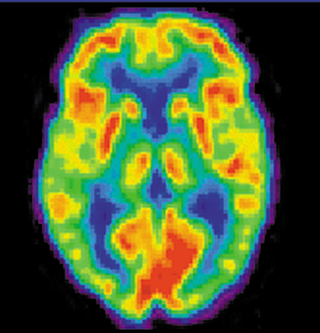 PET Scan of 20-year-old Brain,1 of 2