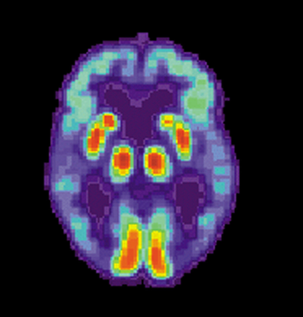 PET Scan of Alzheimer's Disease Brain