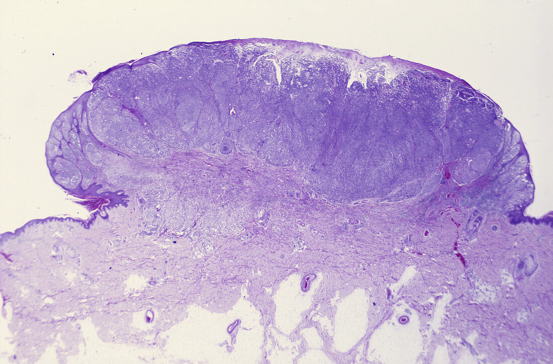 Melanoma,LM