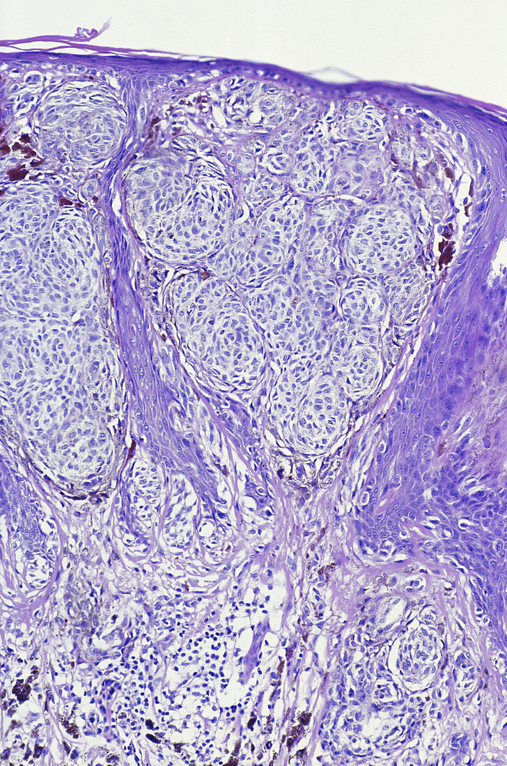 Melanoma,LM