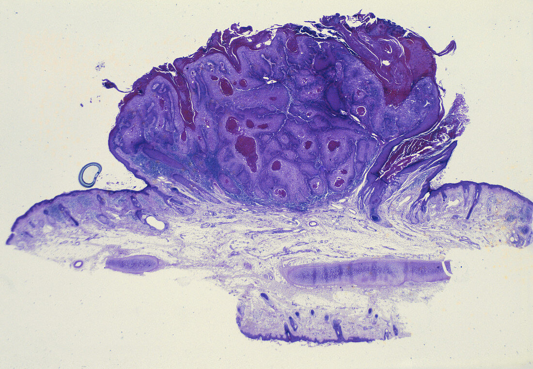 Squamous Cell Carcinoma,LM