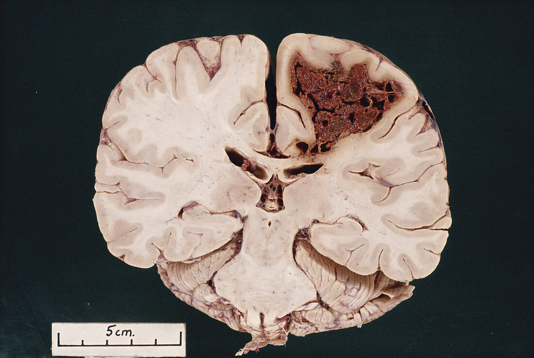 Cerebral Infarction from Embolus