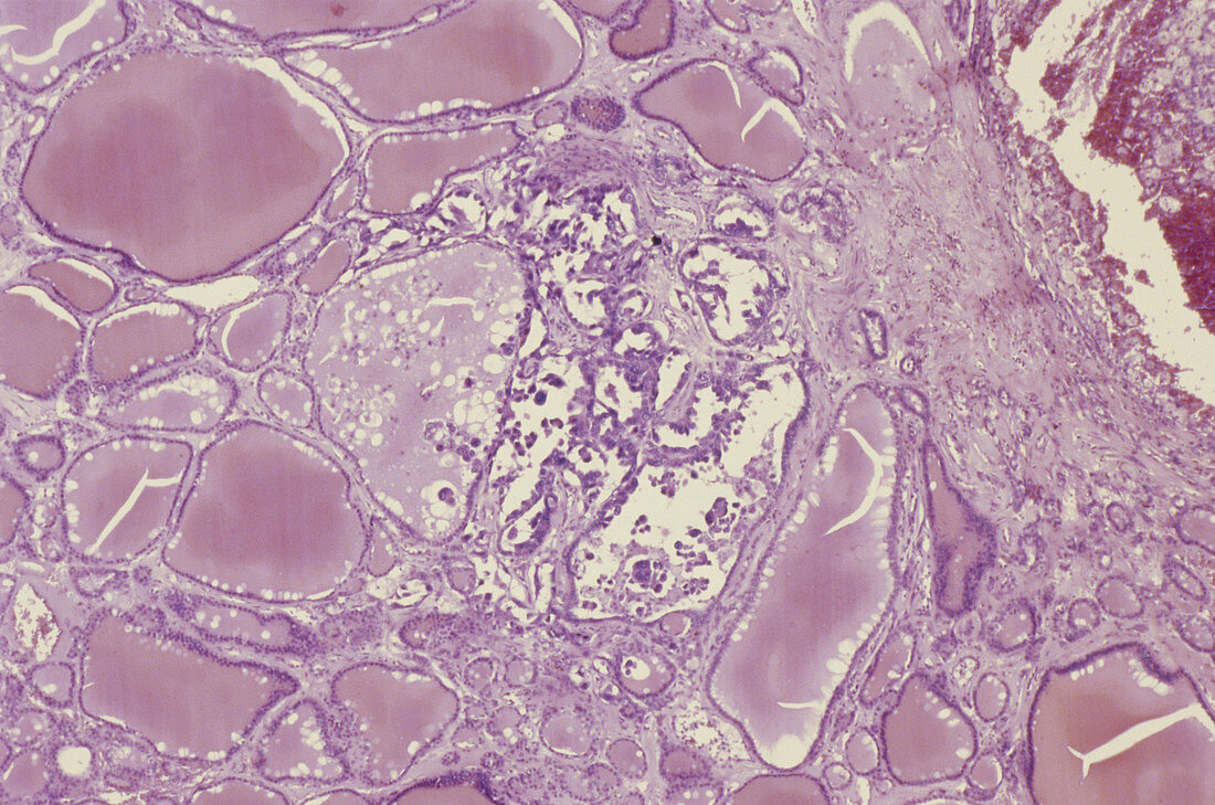 Papillary Adenocarcinoma in Thyroid,LM