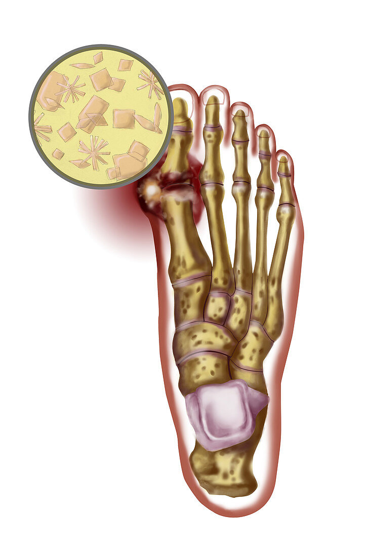 Foot with gout