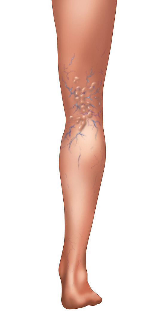 Varicose Veins