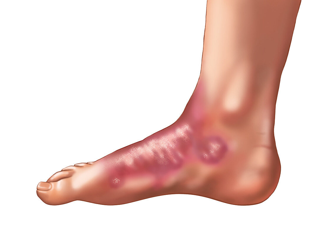 Psoriasis on the Foot