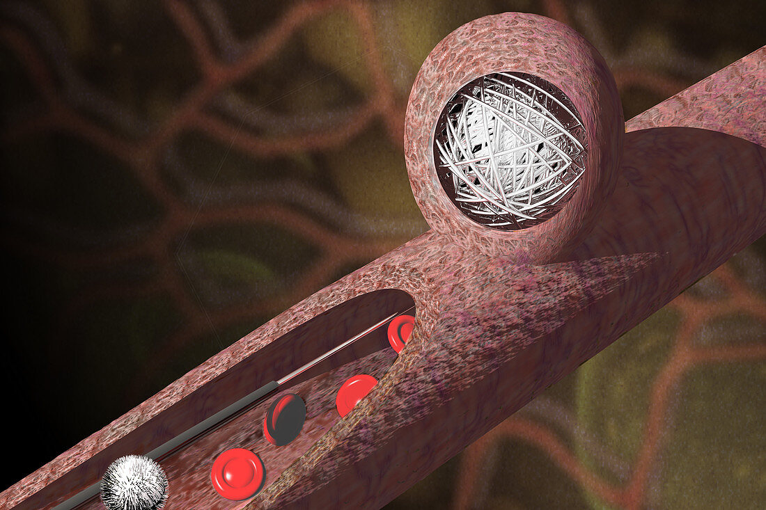 Endovascular Coiling Therapy