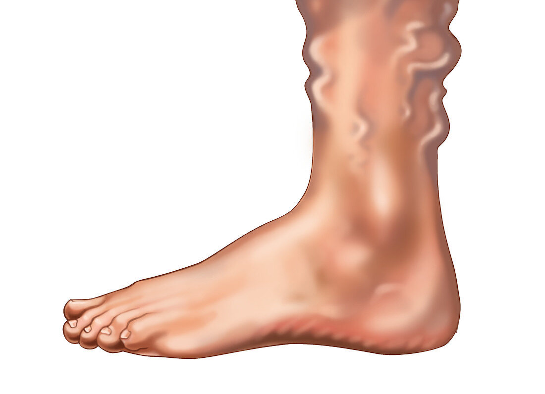 Varicose Veins on the Foot and Ankle
