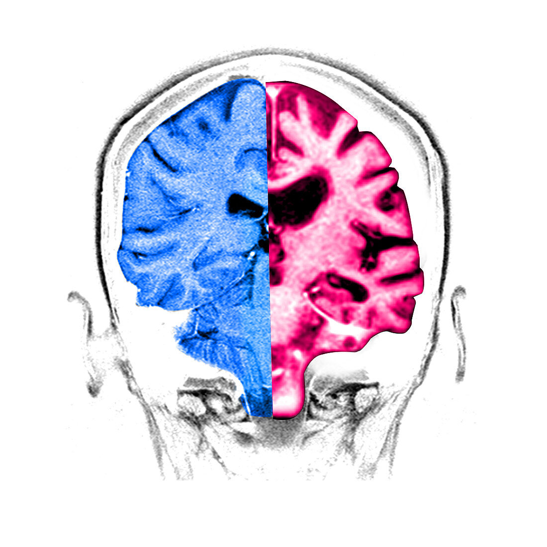 Normal Alzheimer's Brain Comparison