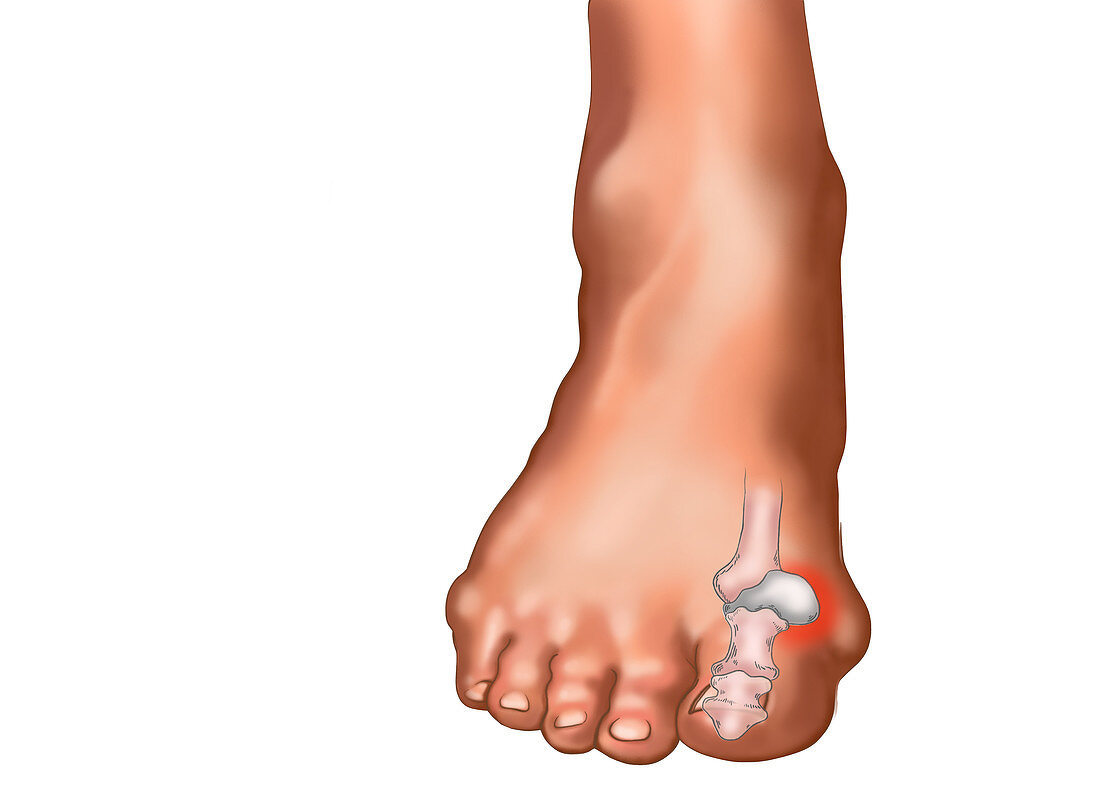 Bunions